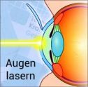 Augen lasern lassen - Kosten?